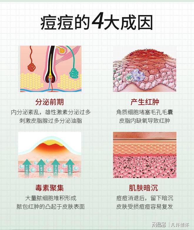 九游娱乐平台：夏日祛痘指南：闭口粉刺最有用的药膏是哪款？(图3)